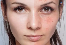 10 روش موثر و کاربردی برای از بین بردن لک های صورت