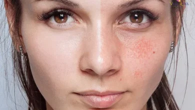 10 روش موثر و کاربردی برای از بین بردن لک های صورت