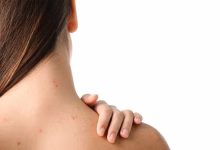 علل و درمان‌های جوش کمر: راهنمای جامع برای داشتن پوستی شفاف