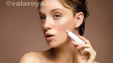 تشخیص انواع جوش های صورت در خانم ها