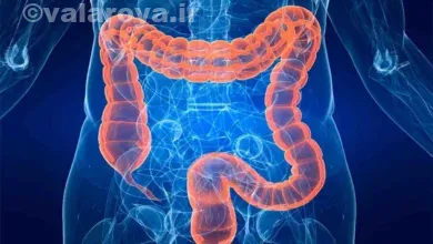 راه های تشخیص سرطان روده