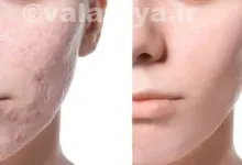 بهترین روش های از بین بردن فرورفتگی های جای جاش در صورت