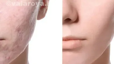 بهترین روش های از بین بردن فرورفتگی های جای جاش در صورت