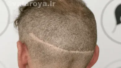 ترمیم زخم های پوست سر پس از کاشت