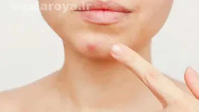 درمان خانگی درمان جوش روی چانه در بانوان