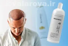 معرفی بهترین شامپو ها بعد از کاشت مو