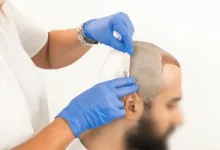 نحوه جلوگیری از عفونت بعد از کاشت مو