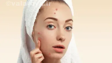 بروز جوشها و آکنههای ناشی از آرایش