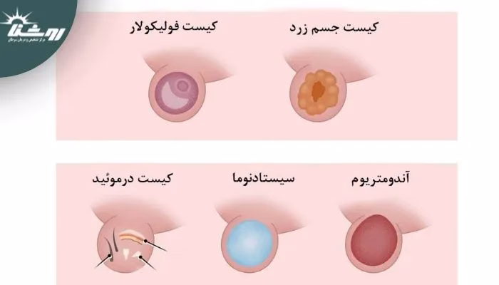 انواع کیست تخمدان