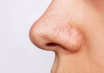 درمان جوش‌های سرسیاه