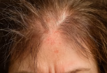 عوارض رنگ مو شیمیایی