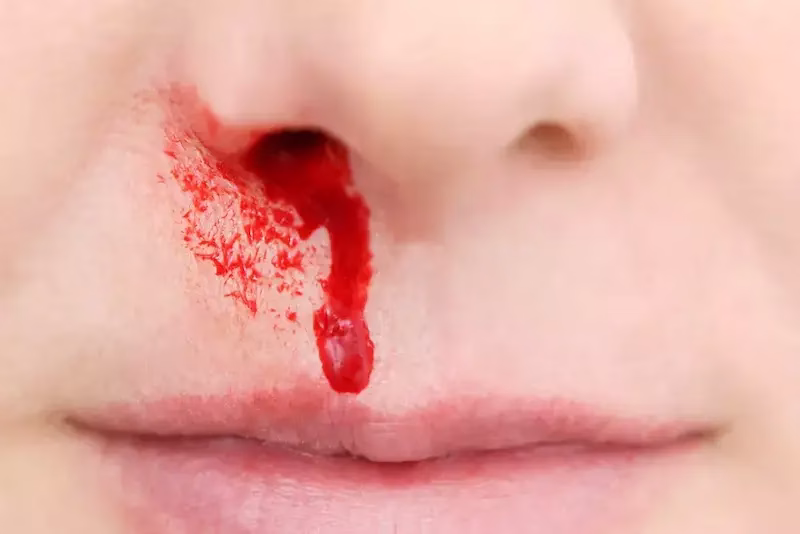 نکات خون دماغ شدن مربوط به گروه‌های خاص