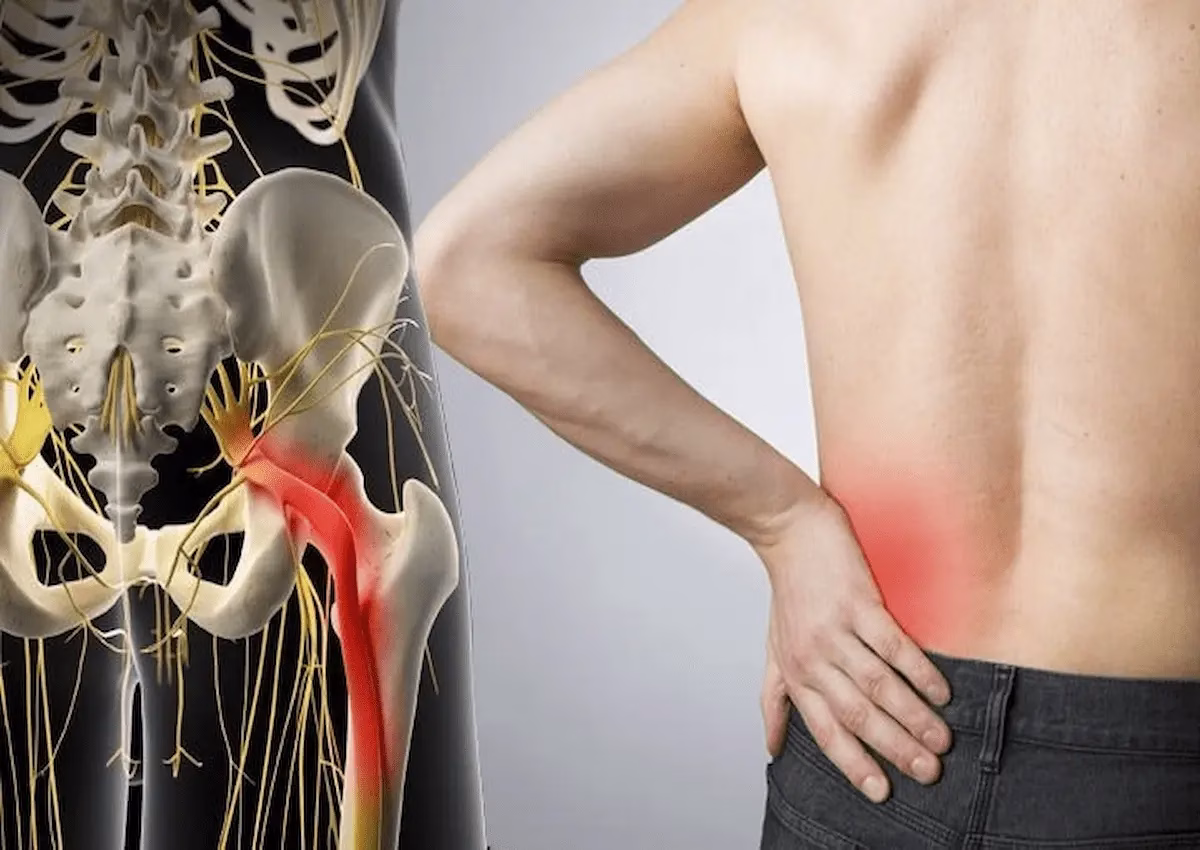 درد عصب سیاتیک