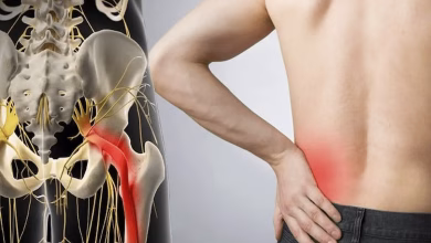 درد عصب سیاتیک