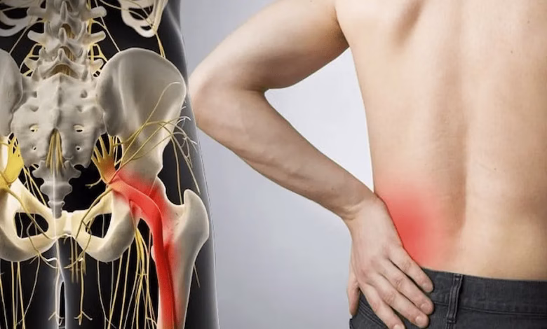 درد عصب سیاتیک